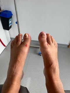 Local anaesthetic injections for nail surgery