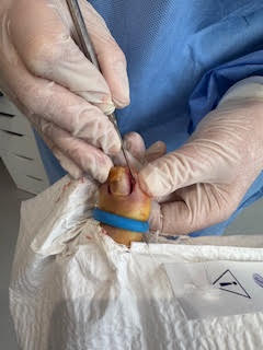 Partial nail removal